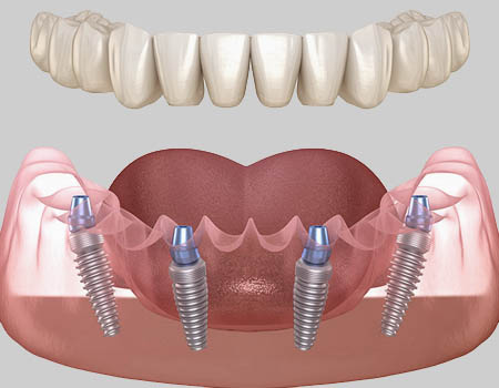 dental implants Turkey