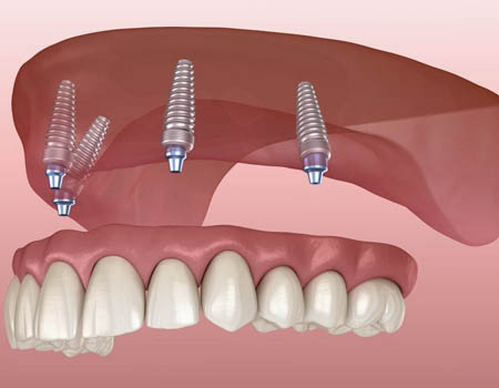 dental implants Turkey