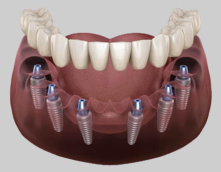 dental implants Turkey