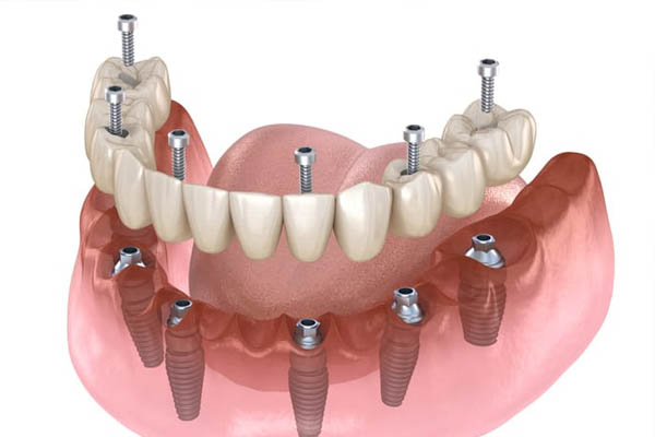 dental treatment