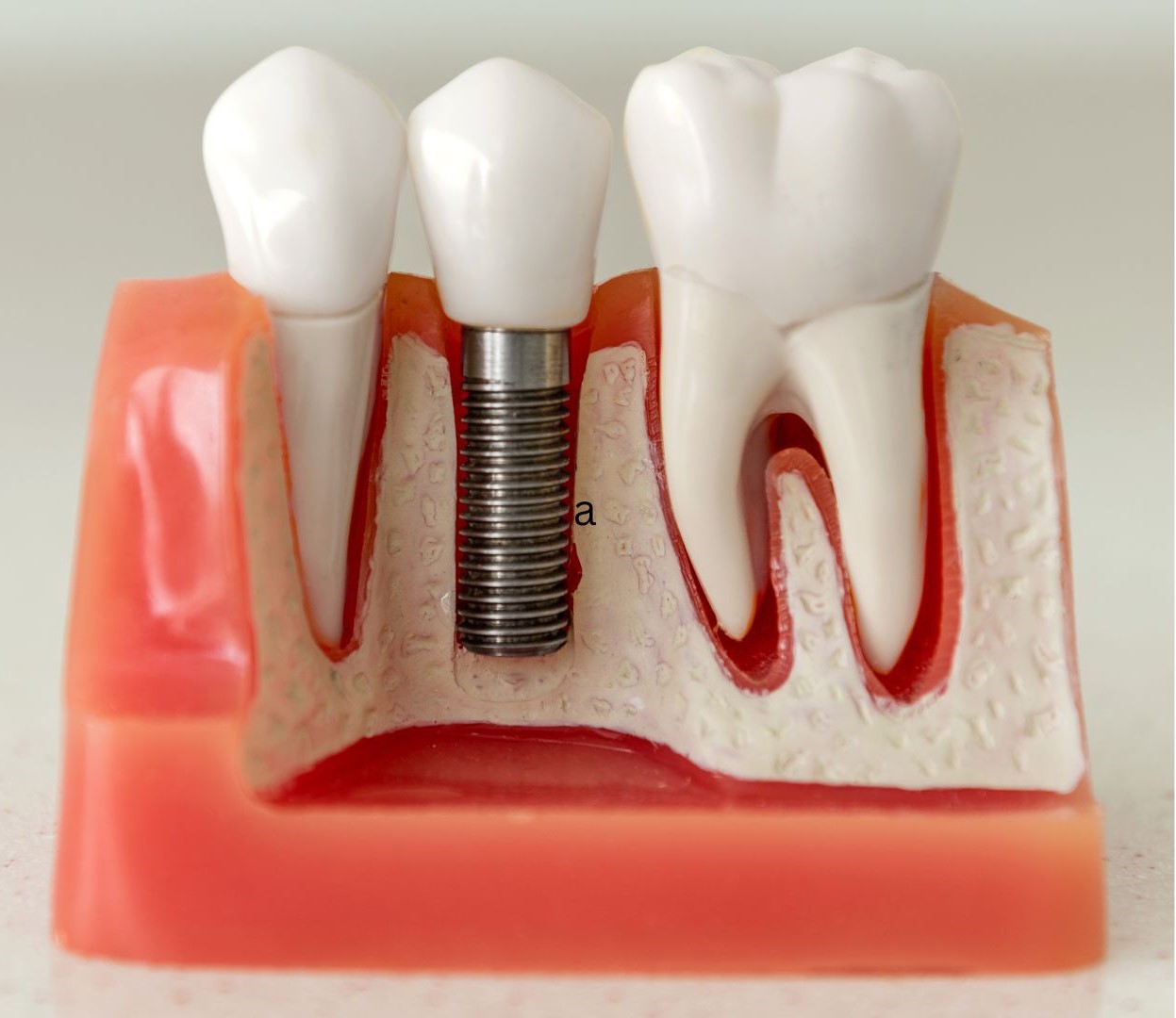 what-is-dental-implant-procedure-turkey