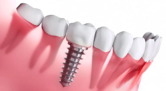 What are the advantages and disadvantages of a dental implant? in Turkey Istanbul Dental Clinic