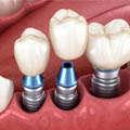 dental implant istanbul