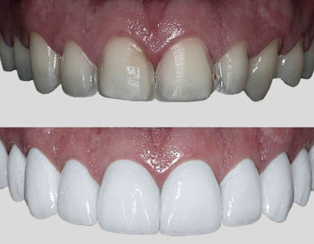 dental implants Turkey