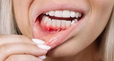 hole-in-gum-causes-symptoms-diagnosis-prevention-turkey