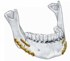 Surgical procedure for mandibular prognathism