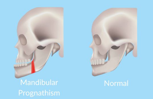 What is Mandibular prognathism?