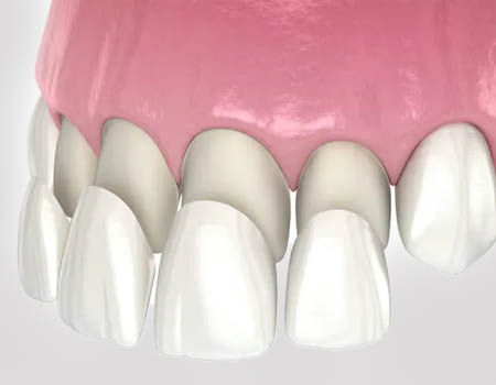 dental implants Turkey