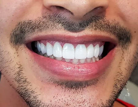 dental implants Turkey