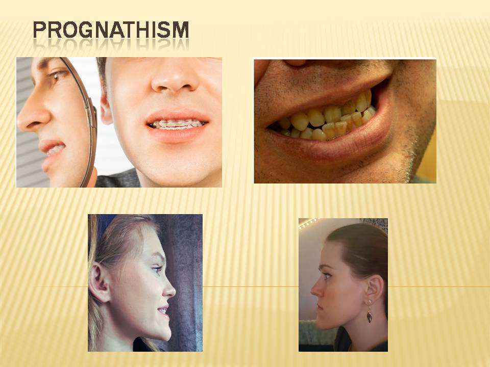 Prognathism