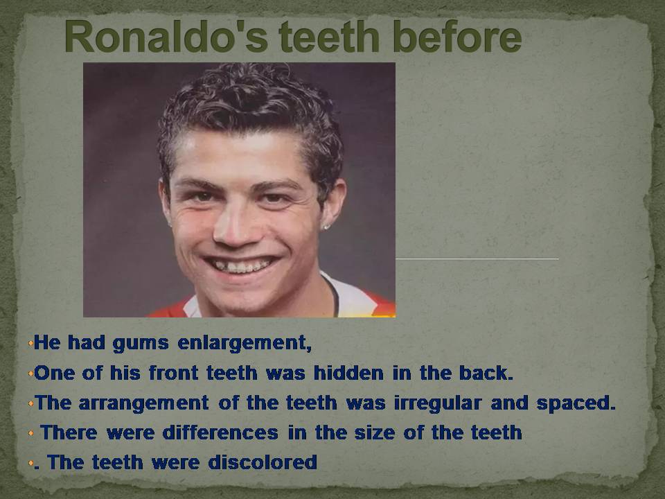 What problems did Ronaldo do with his teeth?