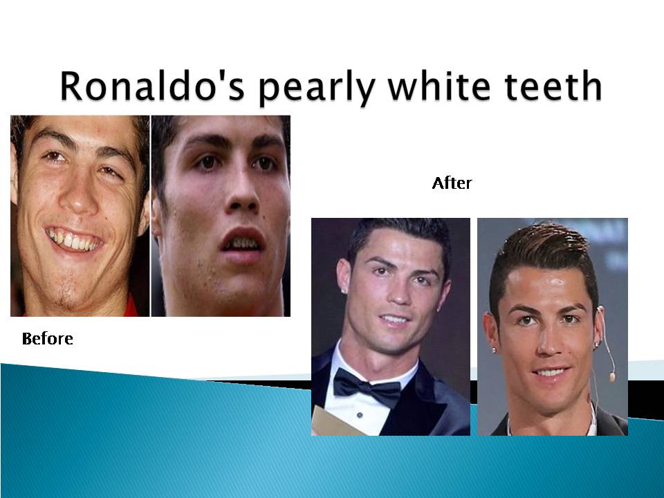 Cristiano Ronaldo teeth whitening