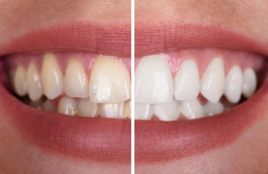 Teeth whitening - Teeth bleachingin Turkey Istanbul