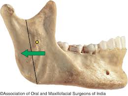 Mandibular prognathism surgery