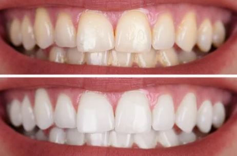 How long does teeth whitening take? in Turkey Istanbul Dental Clinic