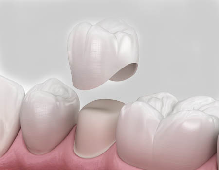 dental implants Turkey